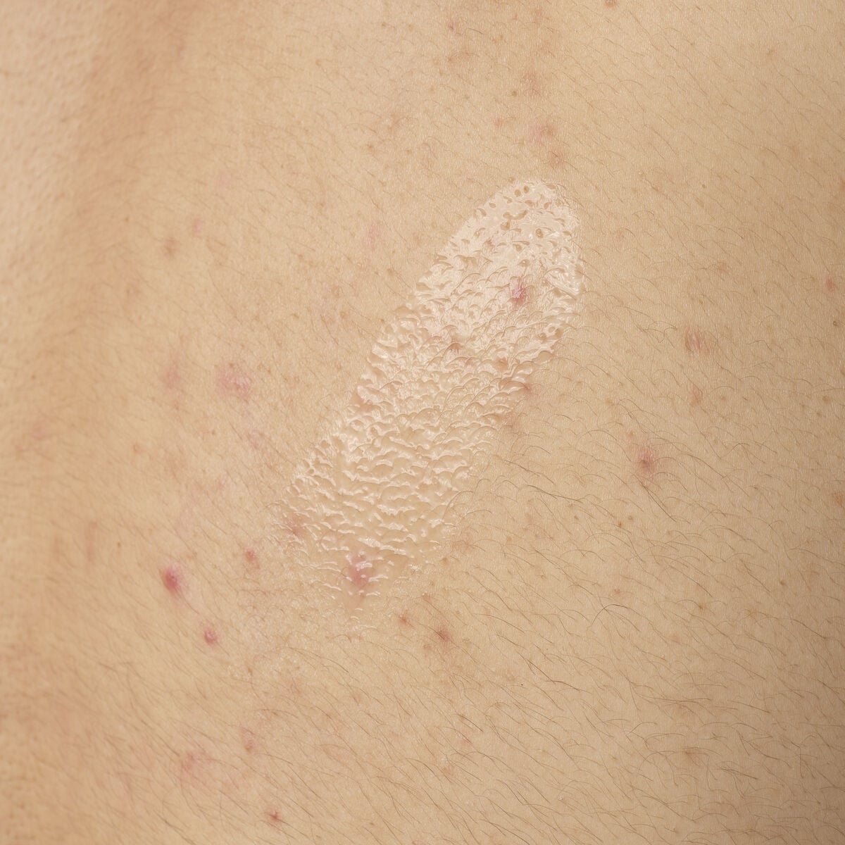 salicylic-acid-0-5-body-serum-a0 ORD-salicylic-acid-05-body-240ml-application.jpg