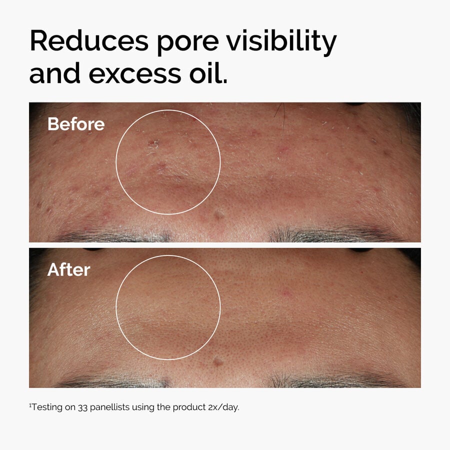niacinamide-10-zinc-1-k7 ord-niacinamide-zinc-blemish-serum-before-after-pores.jpg