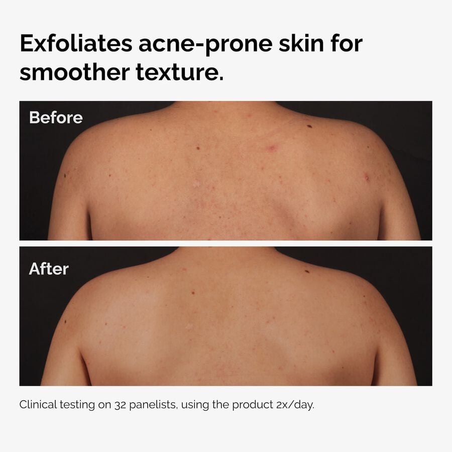 salicylic-acid-0-5-body-serum-a0 ord-salicylic-acid-body-serum-before-after-graphic-NA.jpg